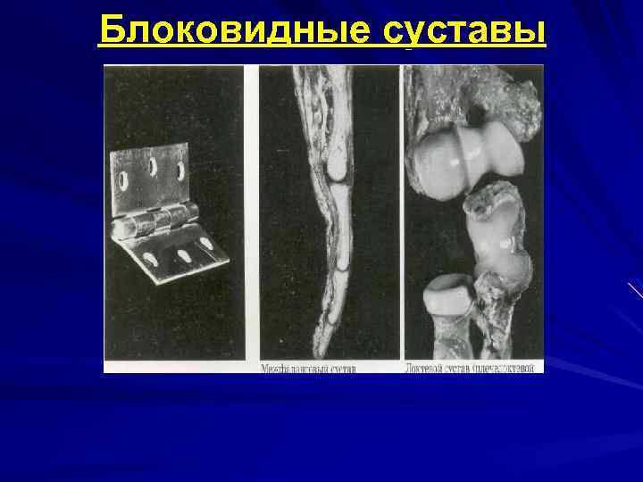 Блоковидные суставы 