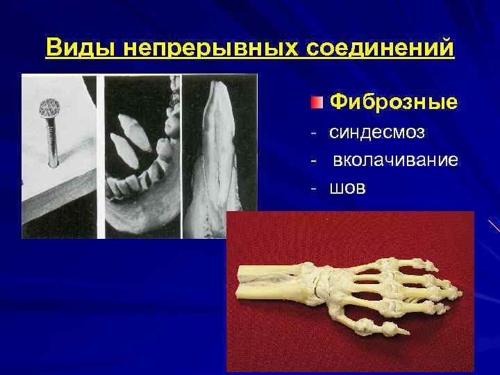 Виды непрерывных соединений Фиброзные - синдесмоз - вколачивание - шов 