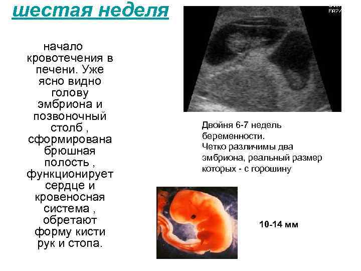 шестая неделя начало кровотечения в печени. Уже ясно видно голову эмбриона и позвоночный столб