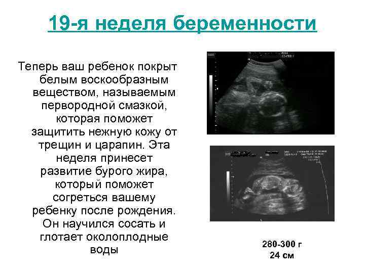 19 -я неделя беременности Теперь ваш ребенок покрыт белым воскообразным веществом, называемым первородной смазкой,