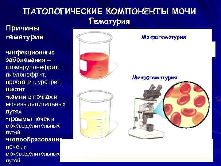 ПАТОЛОГИЧЕСКИЕ КОМПОНЕНТЫ МОЧИ Гематурия Причины гематурии • инфекционные заболевания – гломерулонефрит, пиелонефрит, простатит, уретрит,
