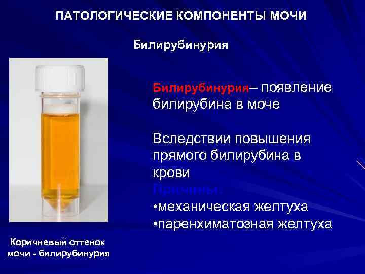ПАТОЛОГИЧЕСКИЕ КОМПОНЕНТЫ МОЧИ Билирубинурия– появление билирубина в моче Вследствии повышения прямого билирубина в крови