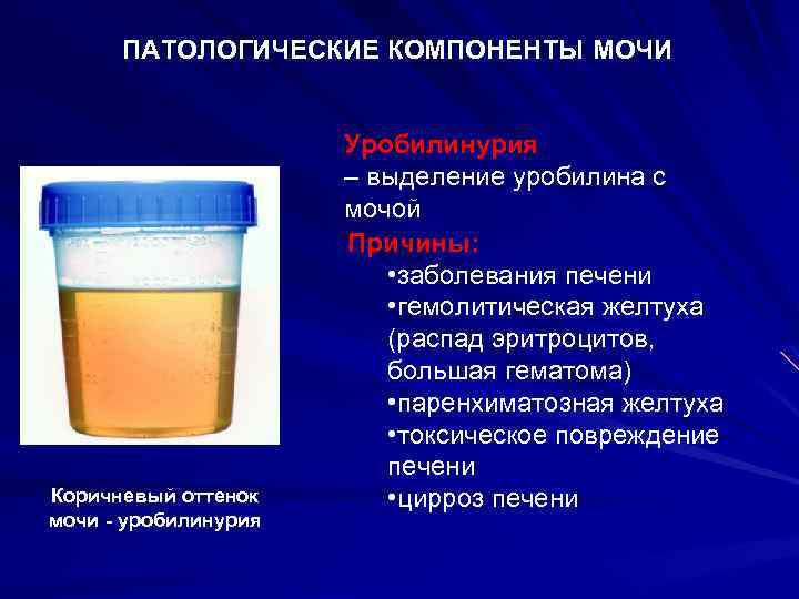 ПАТОЛОГИЧЕСКИЕ КОМПОНЕНТЫ МОЧИ Коричневый оттенок мочи - уробилинурия Уробилинурия – выделение уробилина с мочой