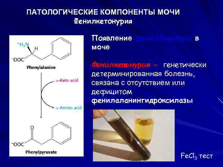 ПАТОЛОГИЧЕСКИЕ КОМПОНЕНТЫ МОЧИ Фенилкетонурия Появление фенилпирувата в моче Фенилкетонурия - генетически детерминированная болезнь, связана