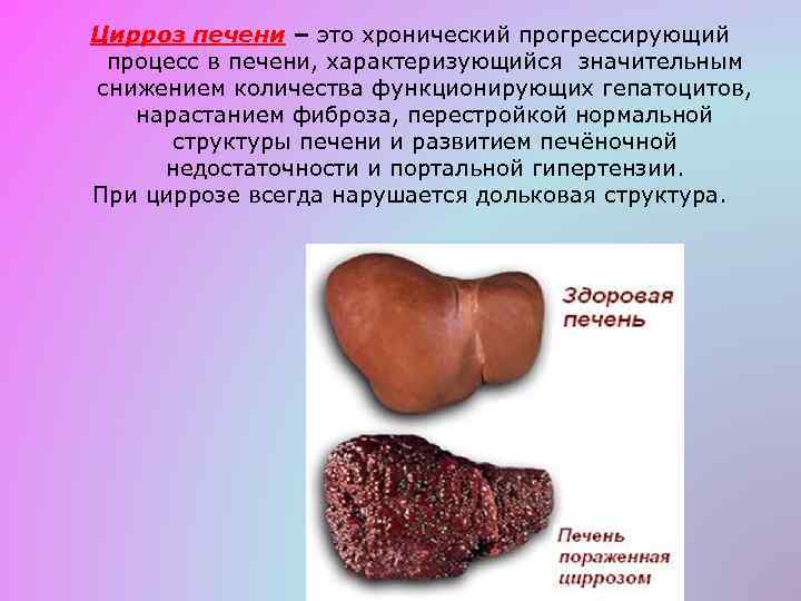 Цирроз печени – это хронический прогрессирующий процесс в печени, характеризующийся значительным снижением количества функционирующих