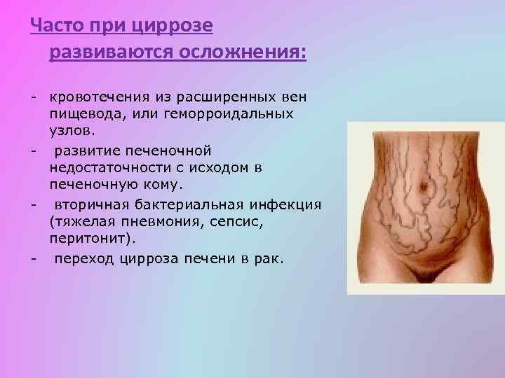 Часто при циррозе развиваются осложнения: - кровотечения из расширенных вен пищевода, или геморроидальных узлов.