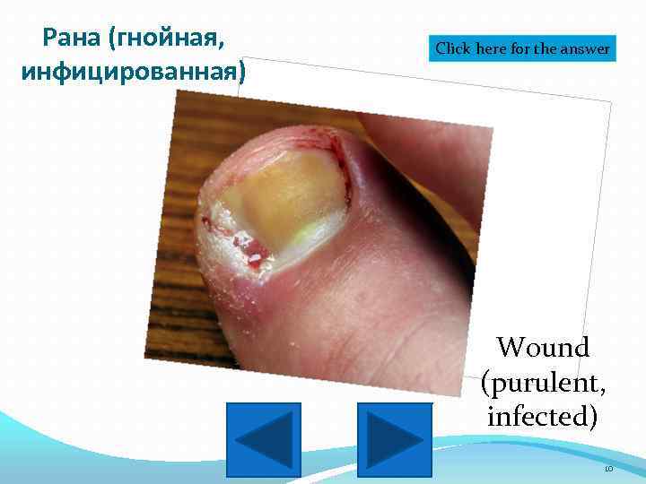 Рана (гнойная, инфицированная) Click here for the answer Wound (purulent, infected) 10 