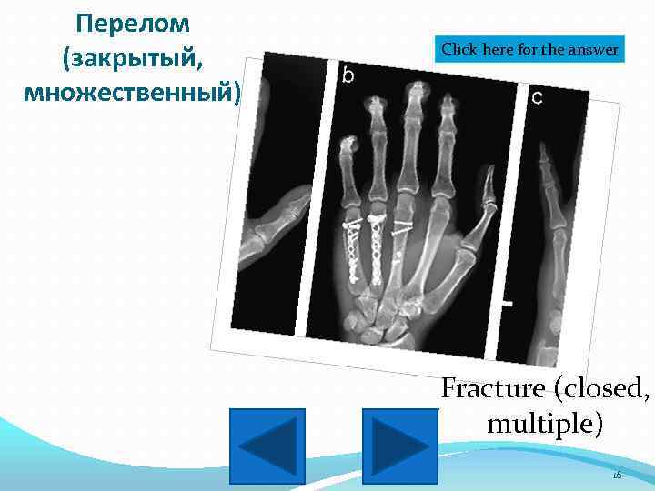 Перелом (закрытый, множественный) Click here for the answer Fracture (closed, multiple) 16 