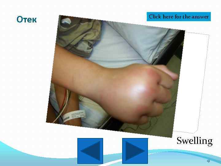 Отек Click here for the answer Swelling 19 