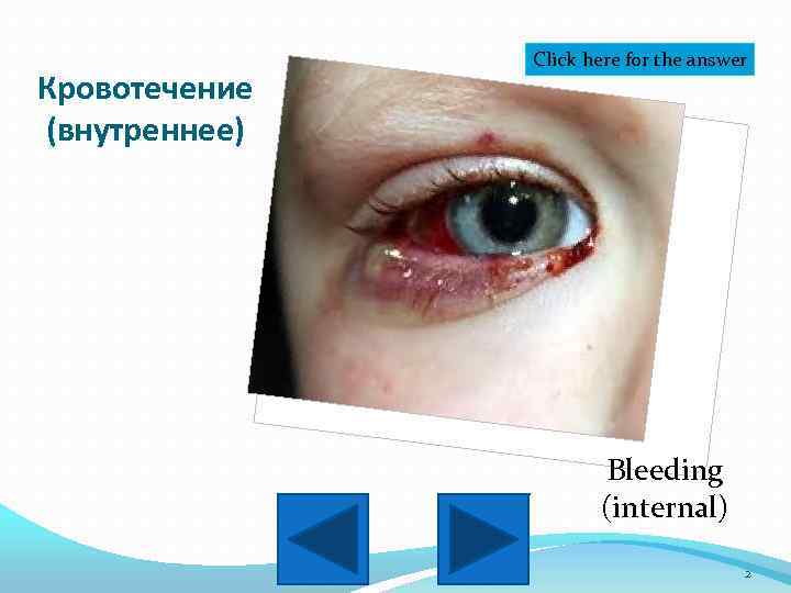 Кровотечение (внутреннее) Click here for the answer Bleeding (internal) 2 