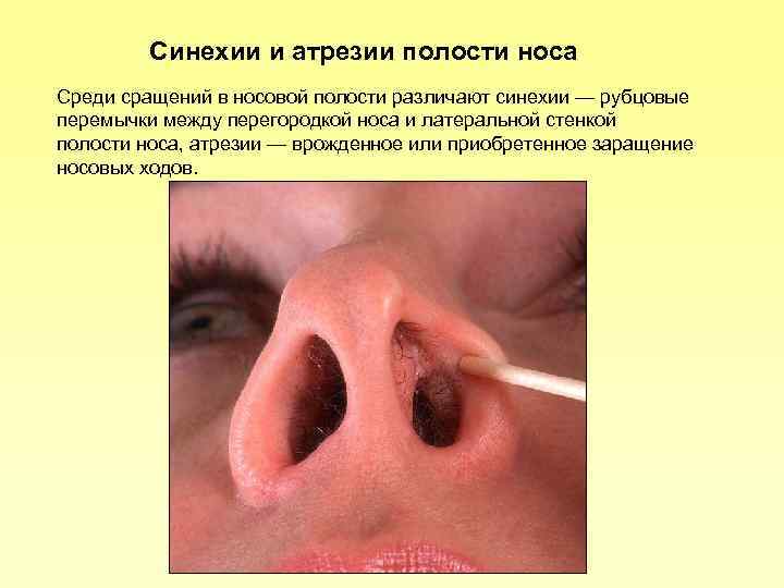 Синехии и атрезии полости носа Среди сращений в носовой полости различают синехии — рубцовые