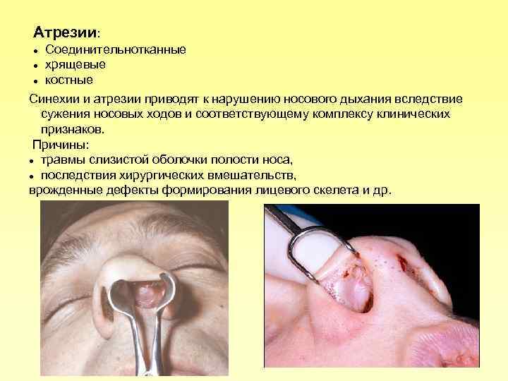Атрезии: Соединительнотканные хрящевые костные Синехии и атрезии приводят к нарушению носового дыхания вследствие сужения