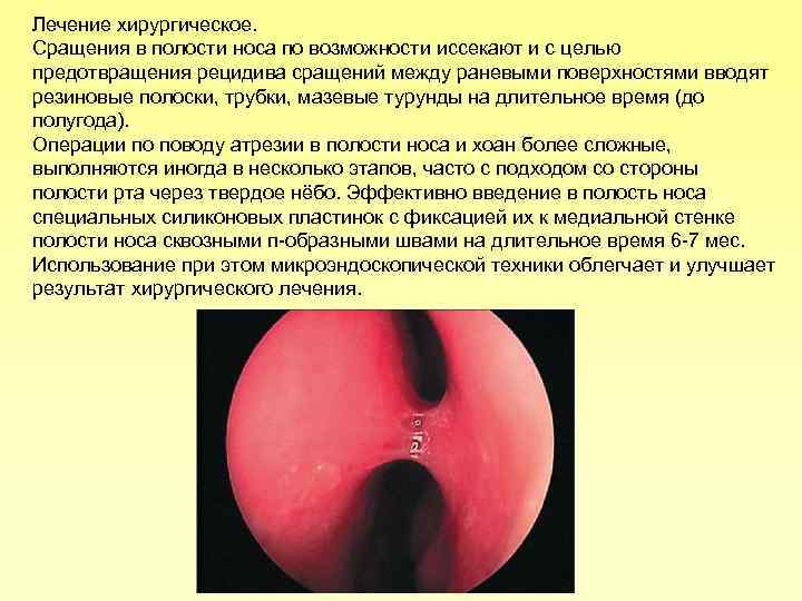 Лечение хирургическое. Сращения в полости носа по возможности иссекают и с целью предотвращения рецидива