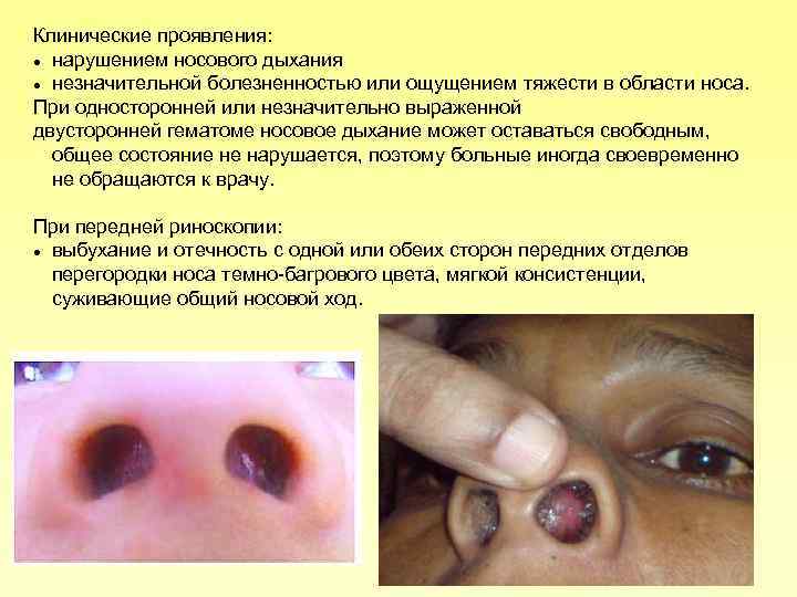 Клинические проявления: нарушением носового дыхания незначительной болезненностью или ощущением тяжести в области носа. При