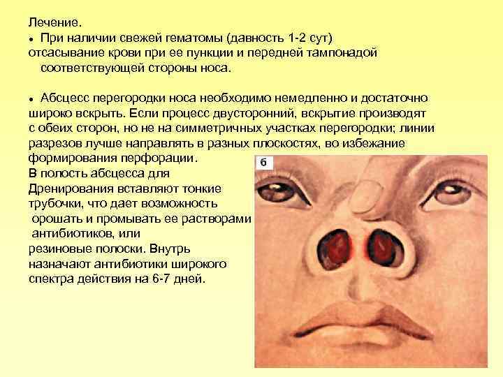 Лечение. При наличии свежей гематомы (давность 1 2 сут) отсасывание крови при ее пункции