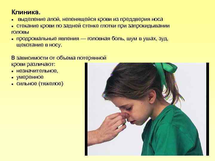 Клиника. выделение алой, непенящейся крови из преддверия носа стекание крови по задней стенке глотки