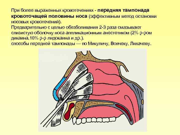 При более выраженных кровотечениях передняя тампонада кровоточащей половины носа (эффективным метод остановки носовых кровотечений).