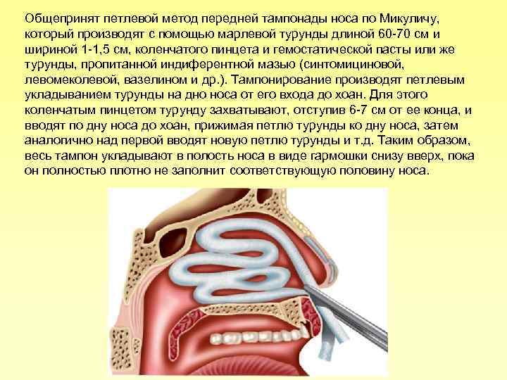 Общепринят петлевой метод передней тампонады носа по Микуличу, который производят с помощью марлевой турунды