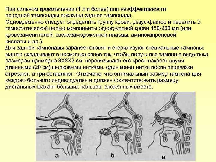При сильном кровотечении (1 л и более) или неэффективности передней тампонады показана задняя тампонада.