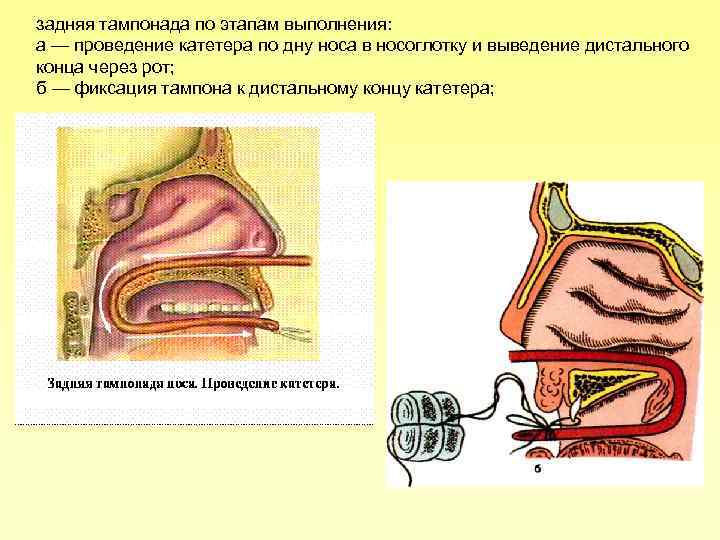 Тампонада носа при кровотечении