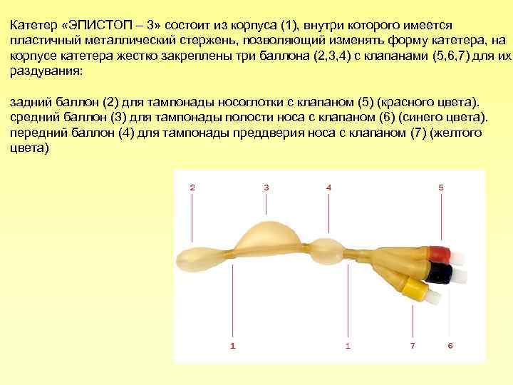 Катетер «ЭПИСТОП – 3» состоит из корпуса (1), внутри которого имеется пластичный металлический стержень,