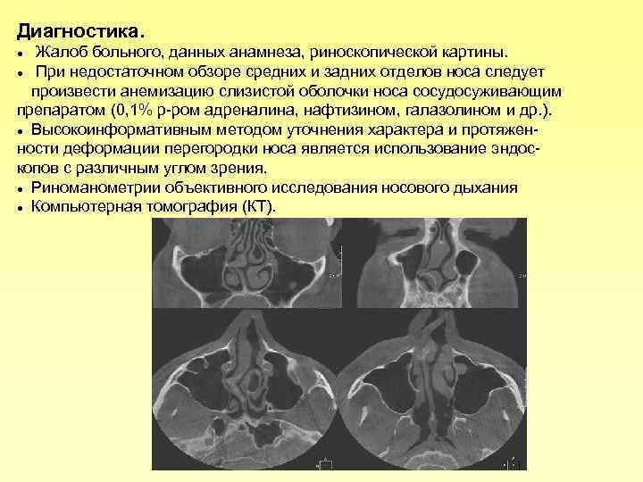 Диагностика. Жалоб больного, данных анамнеза, риноскопической картины. При недостаточном обзоре средних и задних отделов