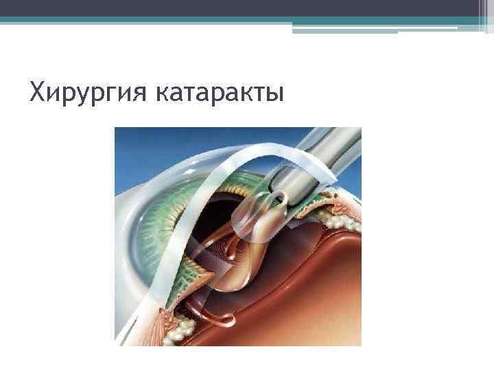 Хирургия катаракты 
