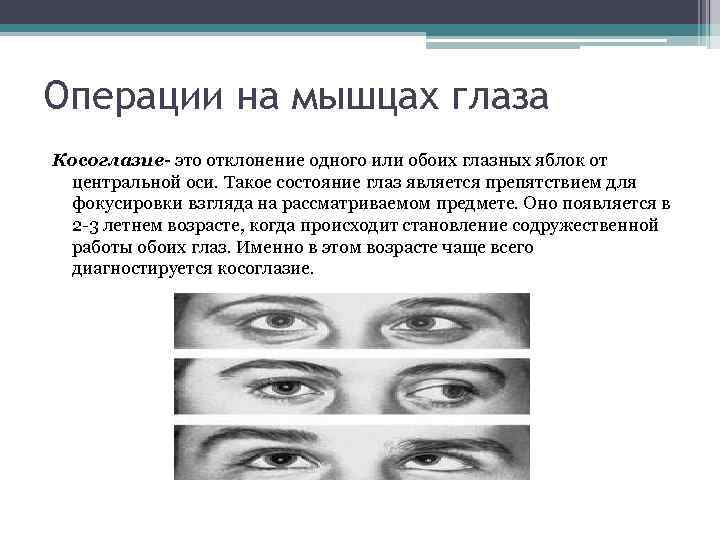 Операция на косоглазие. Операции на мышцах глаза косоглазие. Резекция мышцы глаза при косоглазии.