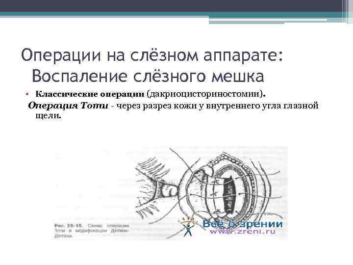 Операции на слёзном аппарате: Воспаление слёзного мешка • Классические операции (дакриоцисториностомии). Операция Тоти -