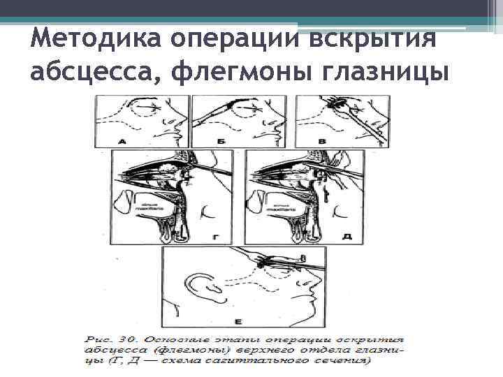 Методика операции вскрытия абсцесса, флегмоны глазницы 
