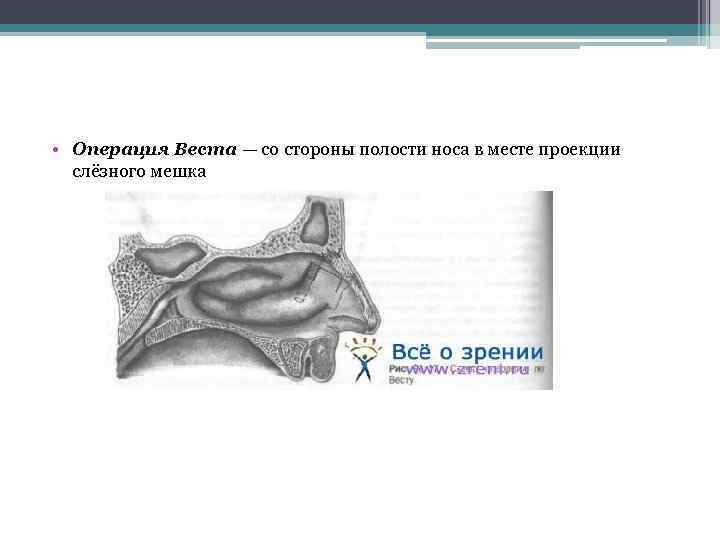  • Операция Веста — со стороны полости носа в месте проекции слёзного мешка