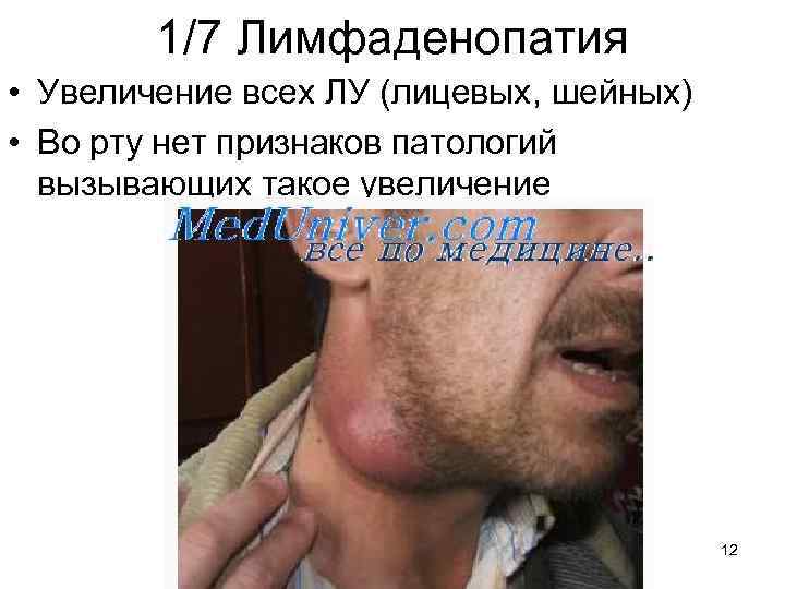 1/7 Лимфаденопатия • Увеличение всех ЛУ (лицевых, шейных) • Во рту нет признаков патологий