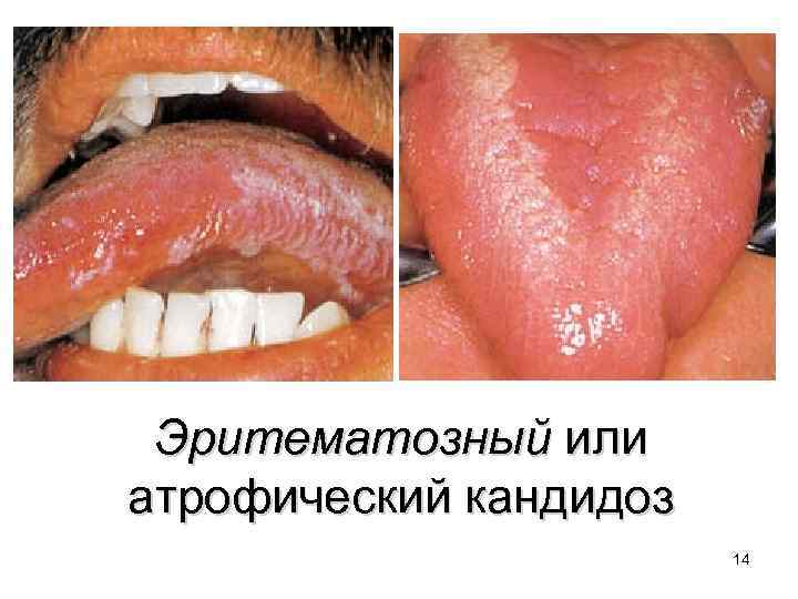Эритематозный или атрофический кандидоз 14 