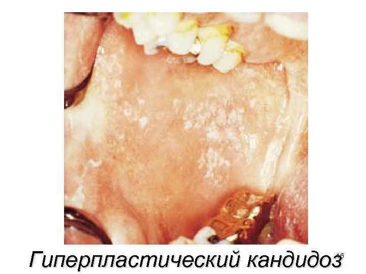 Гиперпластический кандидоз 16 