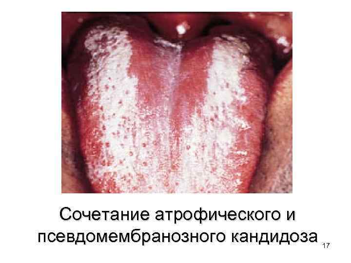 Сочетание атрофического и псевдомембранозного кандидоза 17 