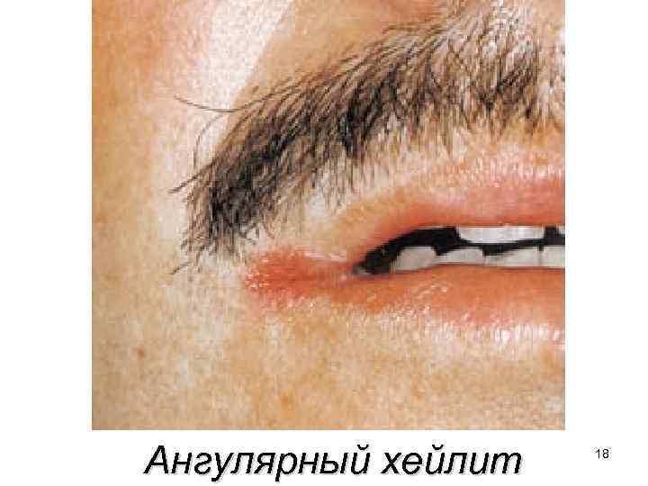Ангулярный хейлит 18 
