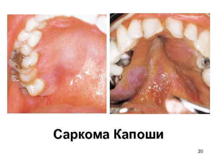 Саркома Капоши 20 