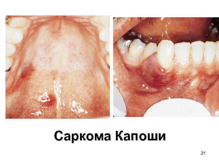 Саркома Капоши 21 