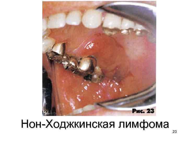 Нон-Ходжкинская лимфома 23 