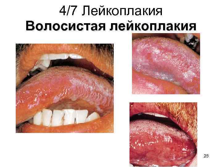 4/7 Лейкоплакия Волосистая лейкоплакия 25 