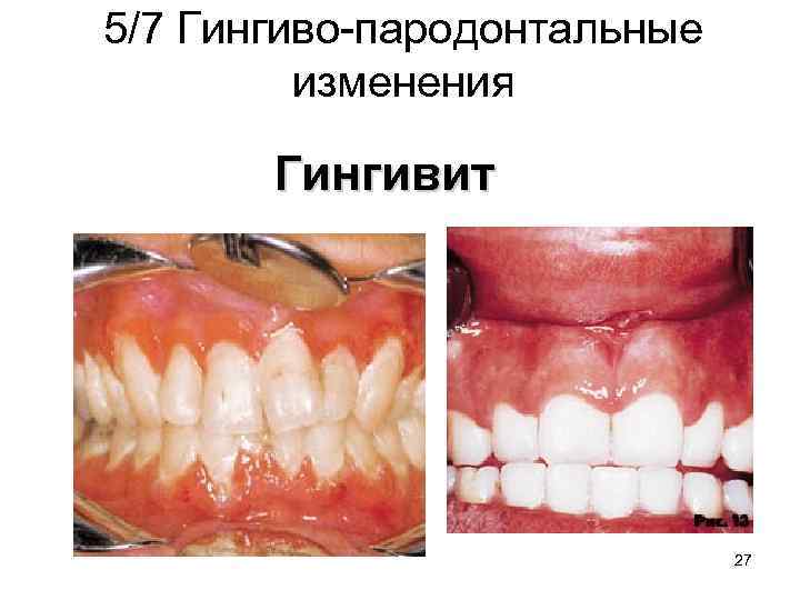 5/7 Гингиво-пародонтальные изменения Гингивит 27 