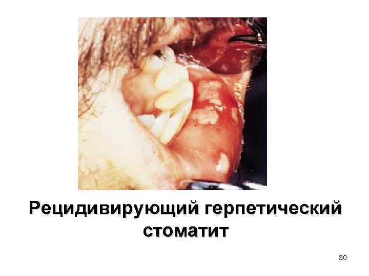 Рецидивирующий герпетический стоматит 30 