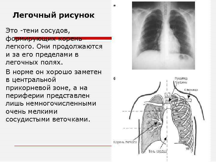 Легочный рисунок усилен в нижних отделах. Легочный рисунок. Нормальный легочный рисунок. Легочный рисунок в норме. Усиленный легочный рисунок.