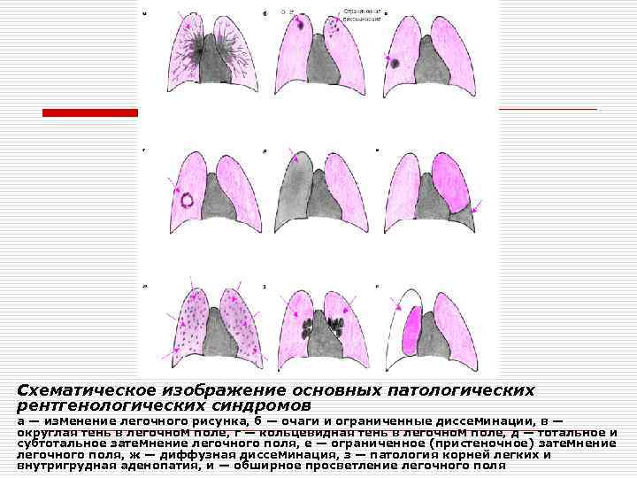 Синдром изменения легочного рисунка