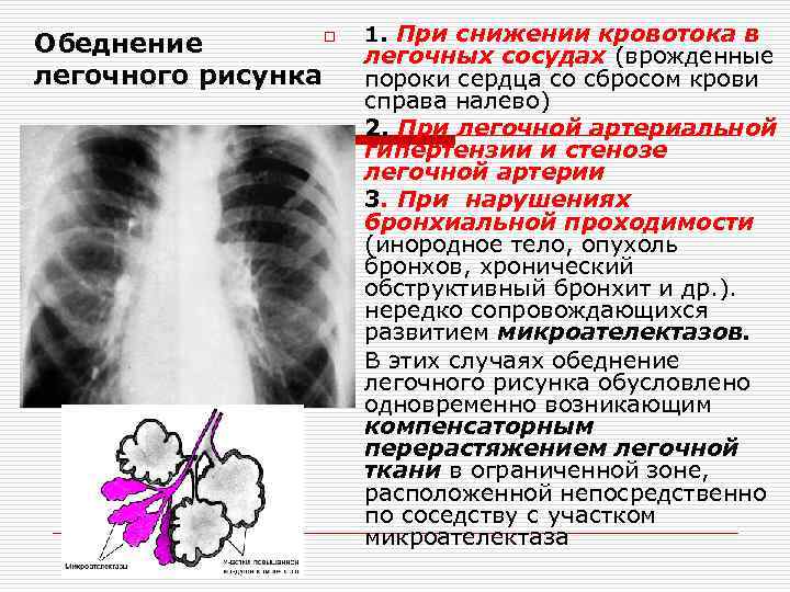 Усиление деформация легочного рисунка в прикорневых и базальных отделах