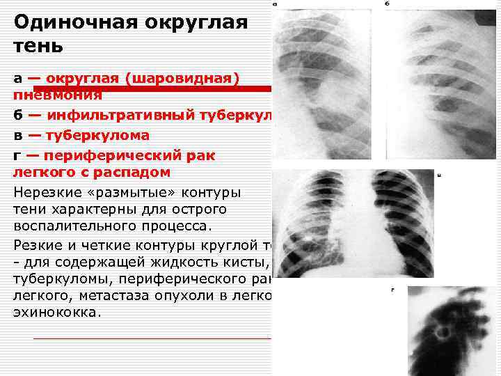 Легочный рисунок при остром воспалительном процессе тест