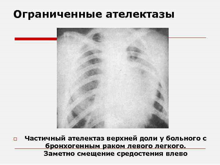 Ограниченные ателектазы o Частичный ателектаз верхней доли у больного с бронхогенным раком левого легкого.