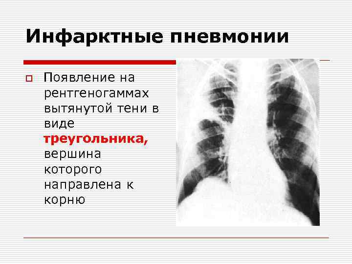 Инфарктные пневмонии o Появление на рентгеногаммах вытянутой тени в виде треугольника, вершина которого направлена