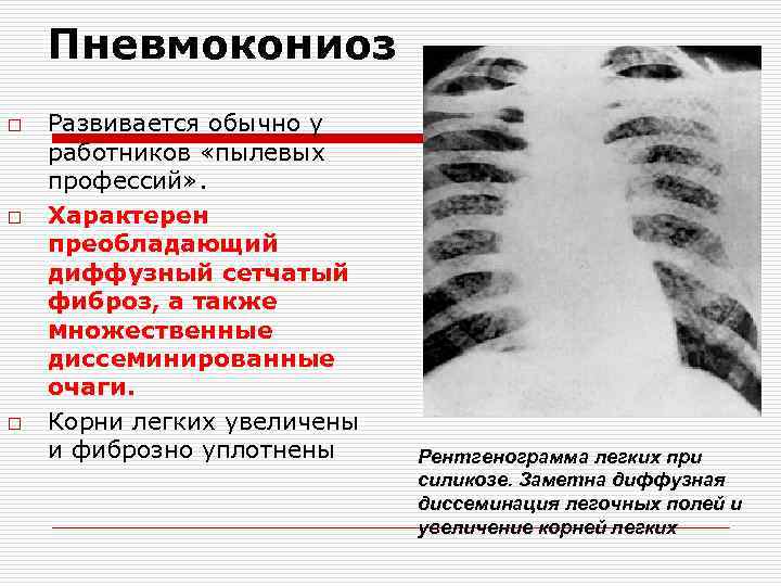 Пневмокониоз