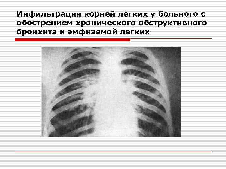 Инфильтрация корней легких у больного с обострением хронического обструктивного бронхита и эмфиземой легких 